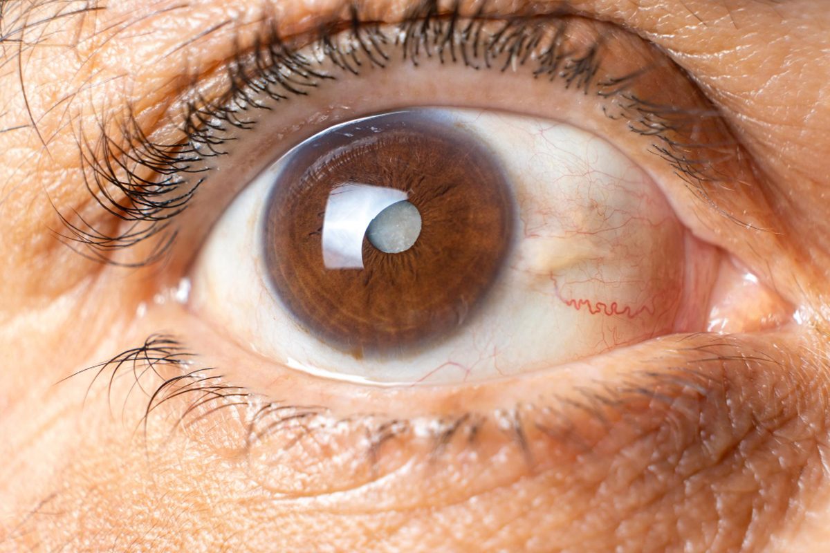 Cataract surgery in Lawrenceville, NJ